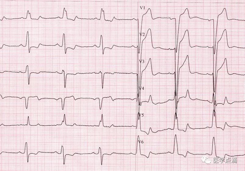 教你用最简单方法学习心电图！