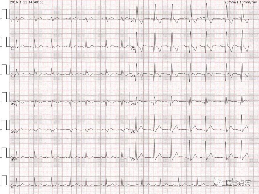 教你用最简单方法学习心电图！