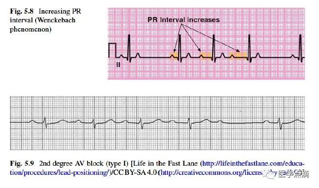 教你用最简单方法学习心电图！