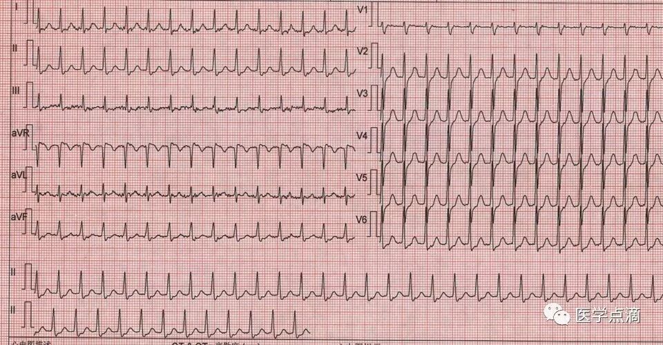教你用最简单方法学习心电图！