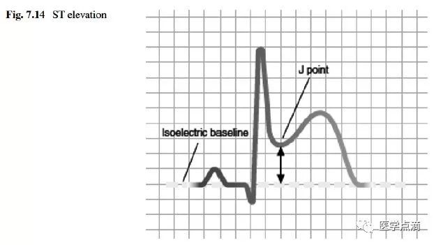 教你用最简单方法学习心电图！