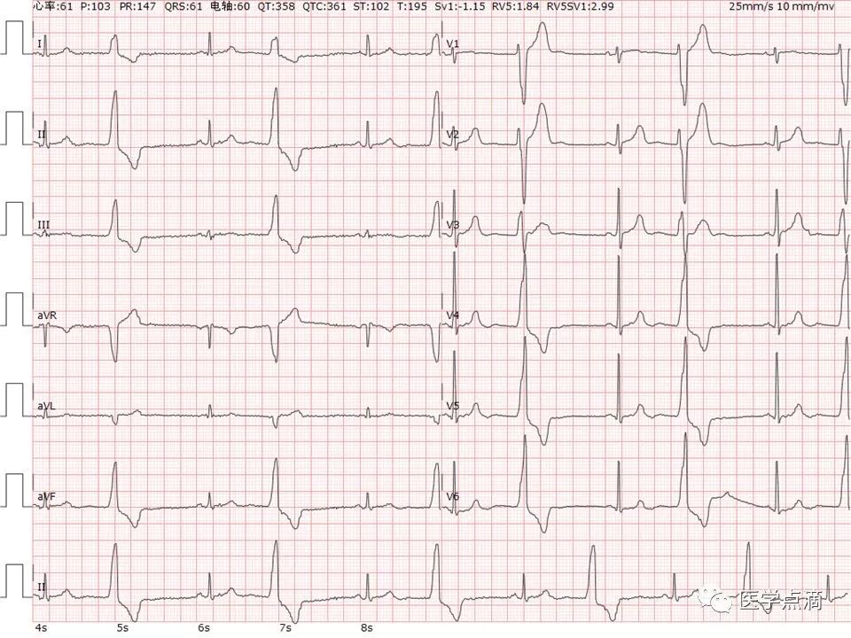 教你用最简单方法学习心电图！