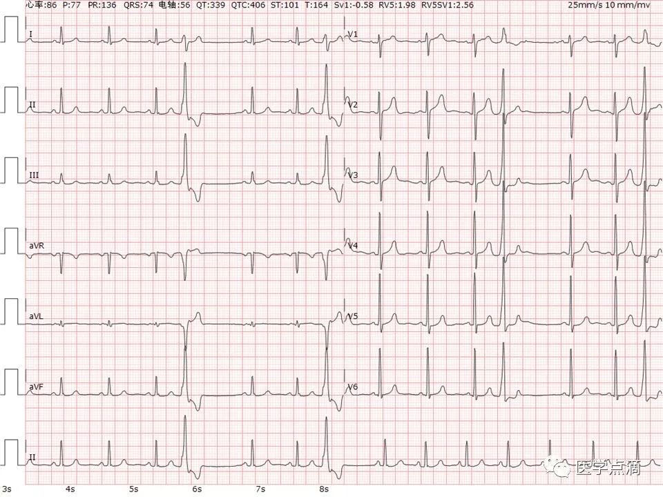 教你用最简单方法学习心电图！