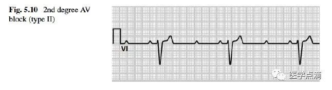 教你用最简单方法学习心电图！