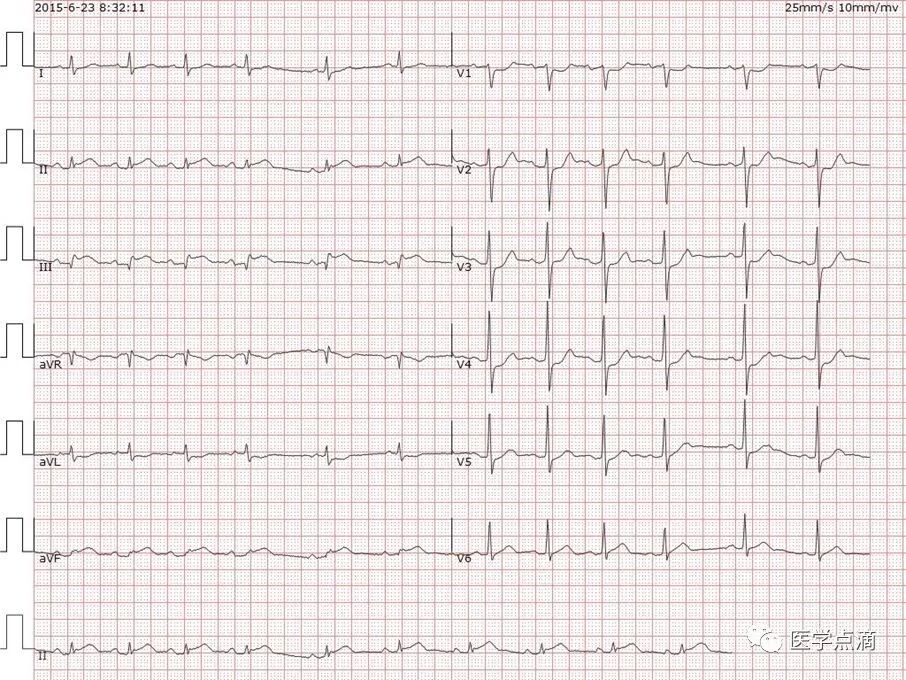 教你用最简单方法学习心电图！