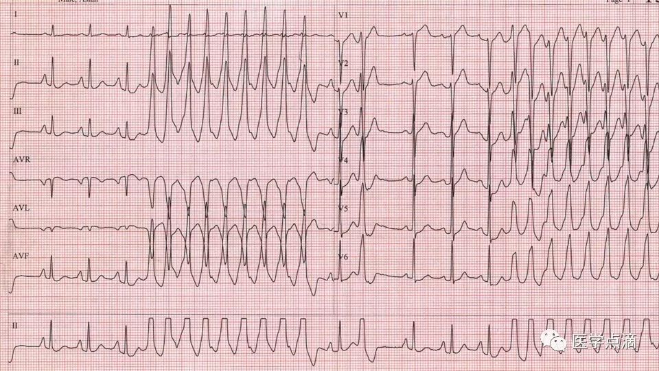 教你用最简单方法学习心电图！