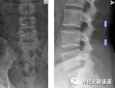 单侧双通道脊柱内镜技术(UBE/BESS),手把手教程!
