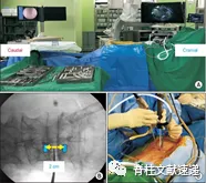 单侧双通道脊柱内镜技术(UBE/BESS),手把手教程!