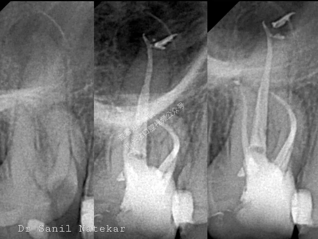 技巧，这样寻找MB2，你认可吗？
