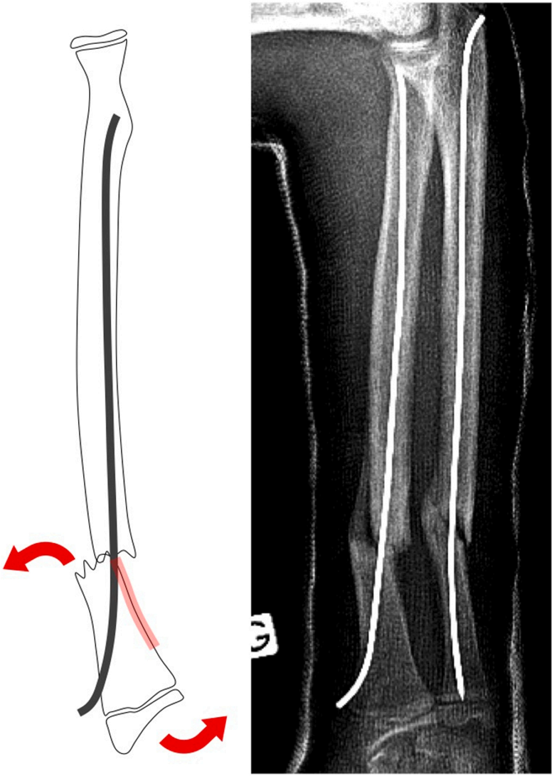 【手术技巧】不仅仅是微创:弹性髓内钉如何应对儿童桡骨骨折的“不稳定”挑战?