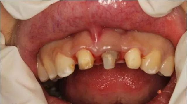 牙冠延长术具体操作,看完这篇就学会!