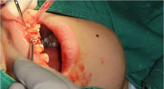 牙冠延长术具体操作,看完这篇就学会!