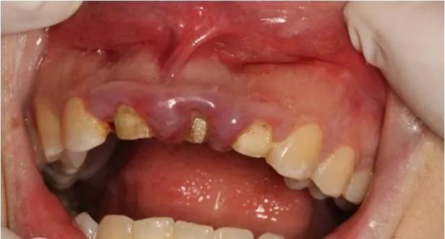 牙冠延长术具体操作,看完这篇就学会!