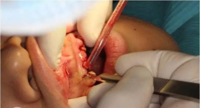 牙冠延长术具体操作,看完这篇就学会!