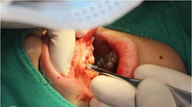 牙冠延长术具体操作,看完这篇就学会!