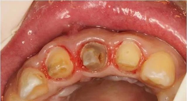 牙冠延长术具体操作,看完这篇就学会!