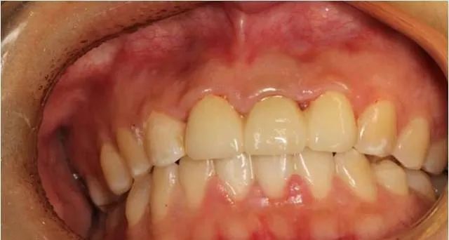 牙冠延长术具体操作,看完这篇就学会!