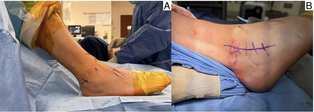 【手术技巧】新型改良