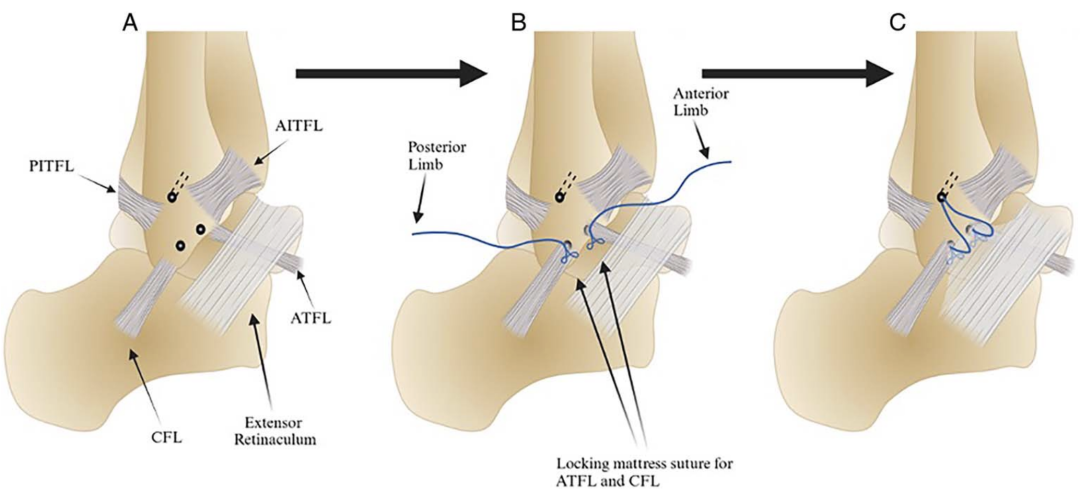 【手术技巧】新型改良