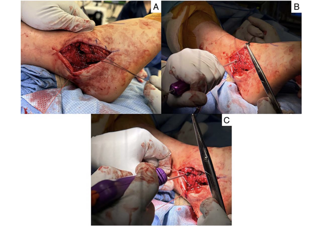 【手术技巧】新型改良
