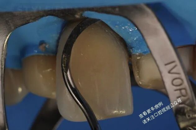 贴面粘接流程:从酸蚀到抛光全步骤(28图详解)