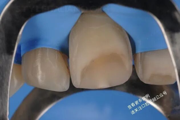 贴面粘接流程:从酸蚀到抛光全步骤(28图详解)