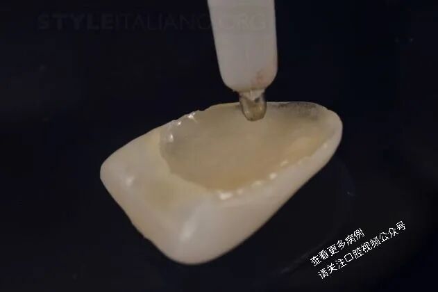 贴面粘接流程:从酸蚀到抛光全步骤(28图详解)