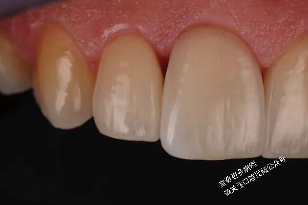 贴面粘接流程:从酸蚀到抛光全步骤(28图详解)