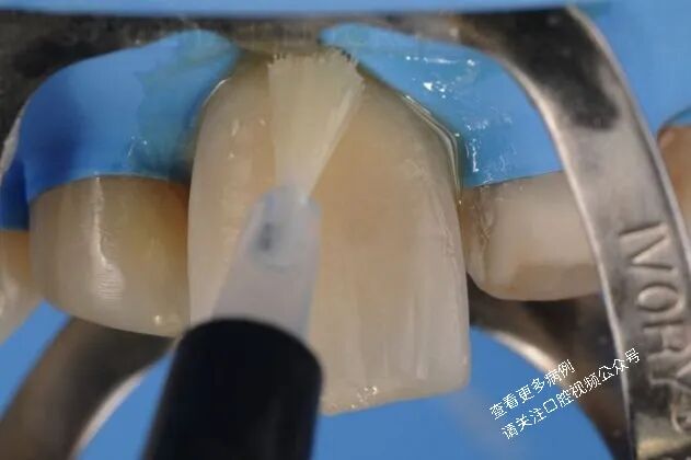 贴面粘接流程:从酸蚀到抛光全步骤(28图详解)
