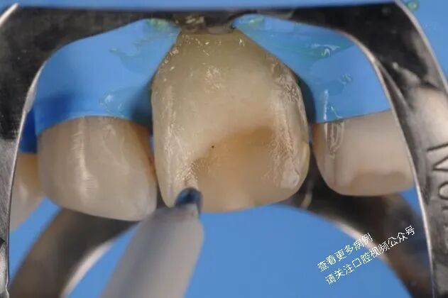 贴面粘接流程:从酸蚀到抛光全步骤(28图详解)