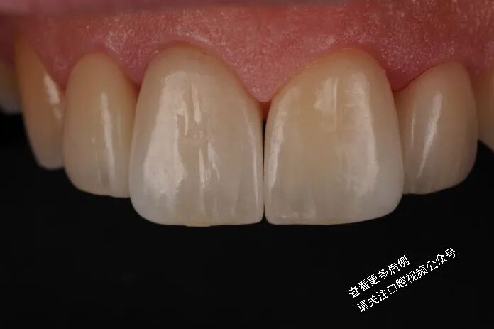 贴面粘接流程:从酸蚀到抛光全步骤(28图详解)