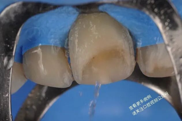 贴面粘接流程:从酸蚀到抛光全步骤(28图详解)