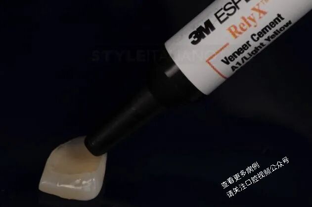 贴面粘接流程:从酸蚀到抛光全步骤(28图详解)