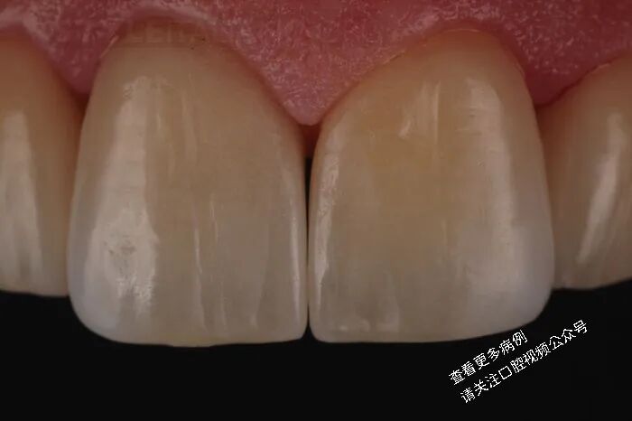 贴面粘接流程:从酸蚀到抛光全步骤(28图详解)
