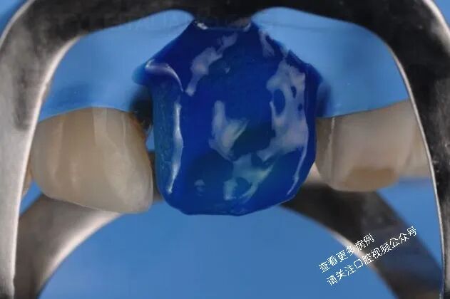 贴面粘接流程:从酸蚀到抛光全步骤(28图详解)