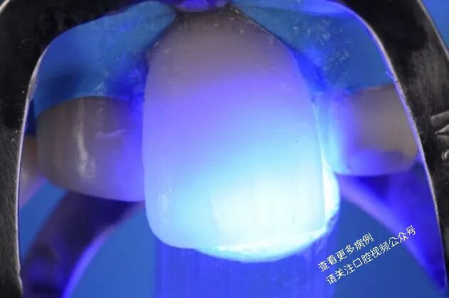 贴面粘接流程:从酸蚀到抛光全步骤(28图详解)