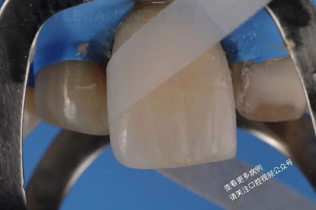 贴面粘接流程:从酸蚀到抛光全步骤(28图详解)