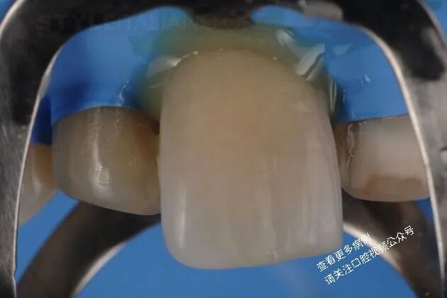 贴面粘接流程:从酸蚀到抛光全步骤(28图详解)