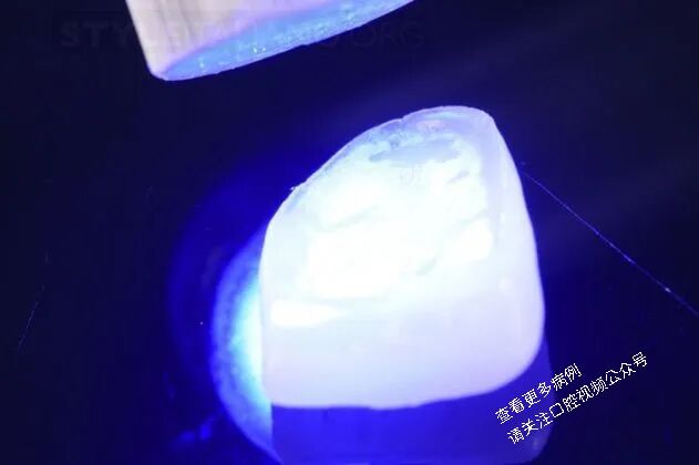 贴面粘接流程:从酸蚀到抛光全步骤(28图详解)