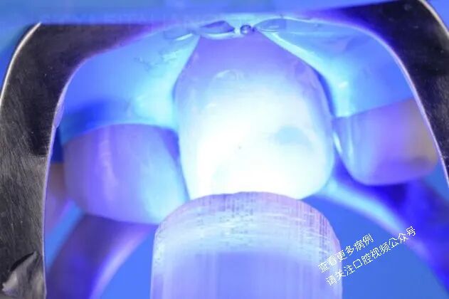 贴面粘接流程:从酸蚀到抛光全步骤(28图详解)