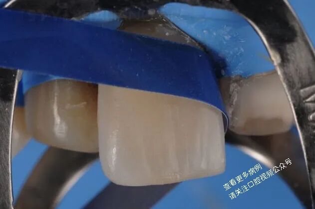 贴面粘接流程:从酸蚀到抛光全步骤(28图详解)