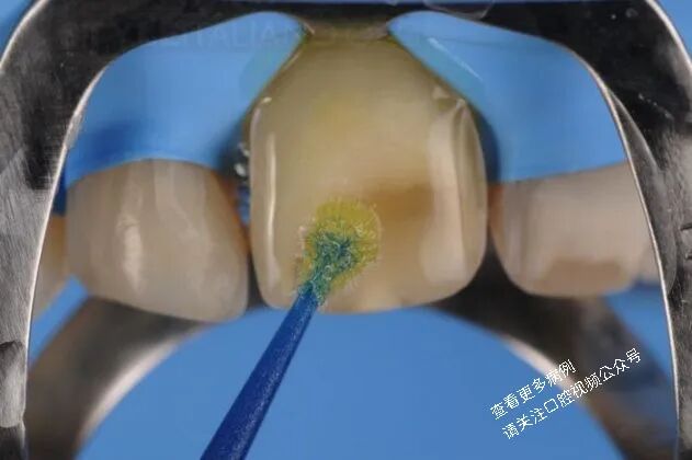 贴面粘接流程:从酸蚀到抛光全步骤(28图详解)