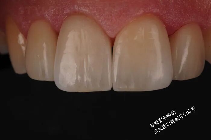 贴面粘接流程:从酸蚀到抛光全步骤(28图详解)