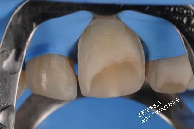 贴面粘接流程:从酸蚀到抛光全步骤(28图详解)