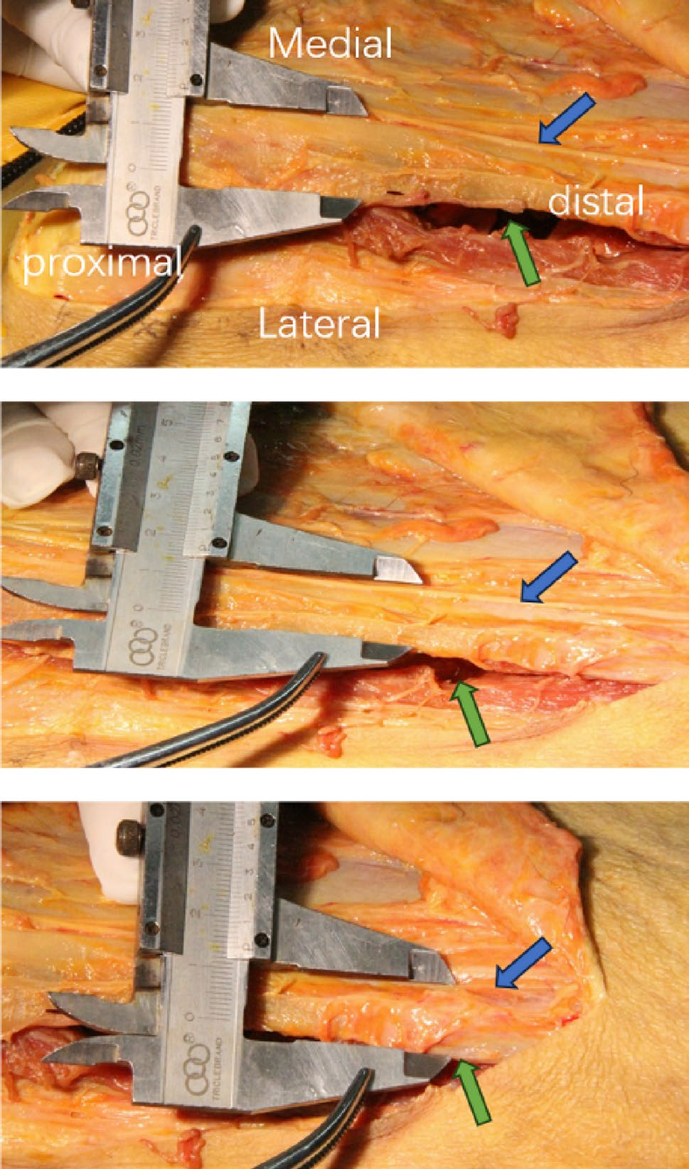 DAA全髋置换:关键解剖标志与操作要点