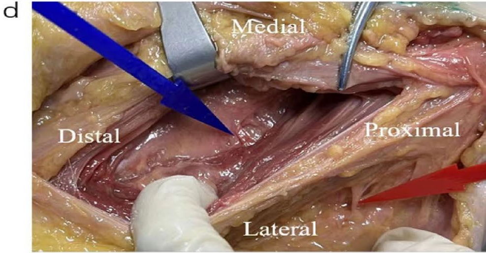 DAA全髋置换:关键解剖标志与操作要点