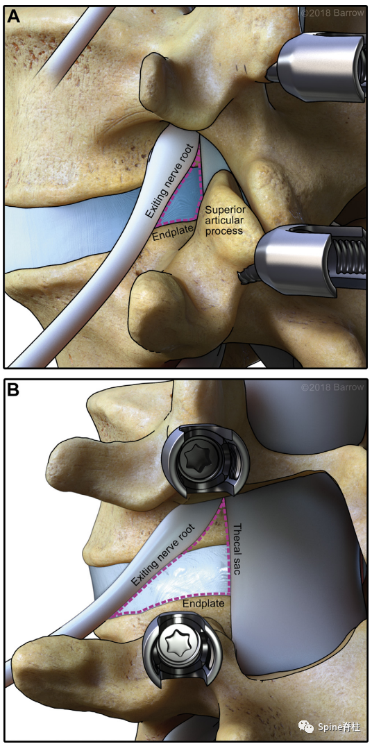 “安全三角”真的安全吗?——脊柱微创里的