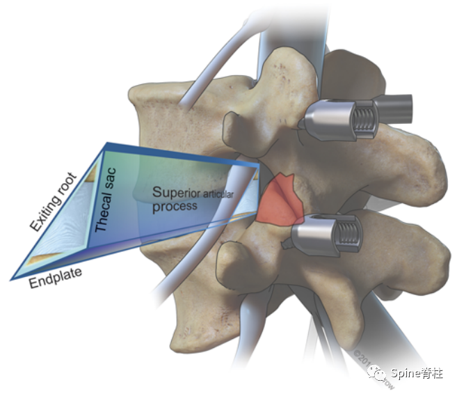 “安全三角”真的安全吗?——脊柱微创里的