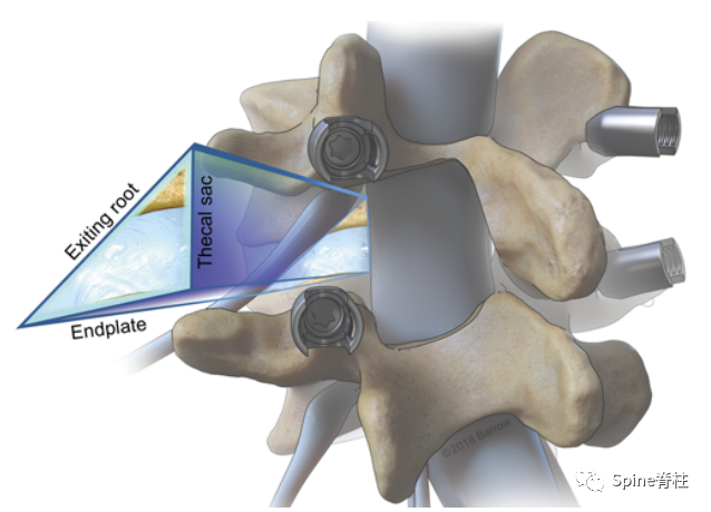 “安全三角”真的安全吗?——脊柱微创里的