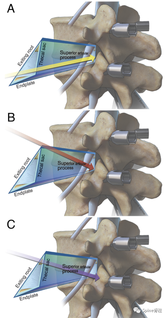 “安全三角”真的安全吗?——脊柱微创里的